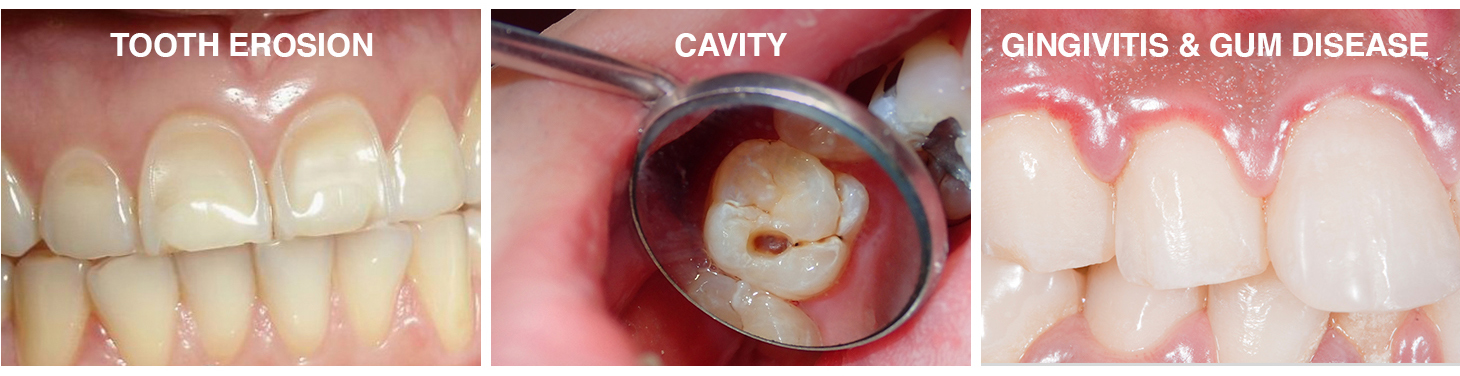 Tooth erosion, cavity and Gingivitis and gum disease